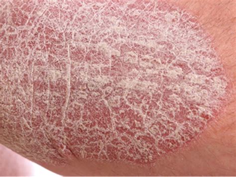 Psoriasis - Diagnóstico y Tratamiento