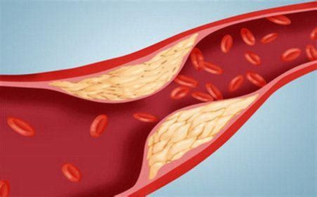 动脉硬化【多图】_39医疗图集-39健康网