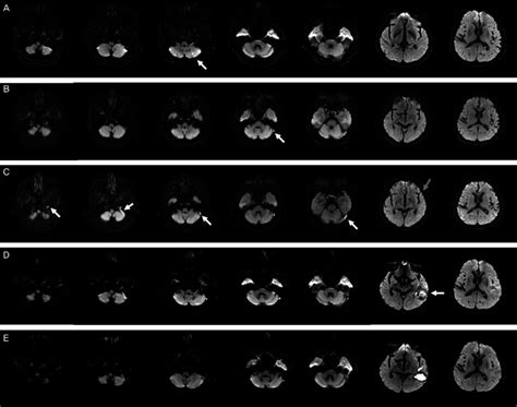 Serial changes of brain diffusion MRI. (A) Initial brain MRI shows a ...