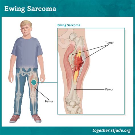 Diagnosing And Treating Ewing Sarcoma In Children - Ask The Nurse Expert