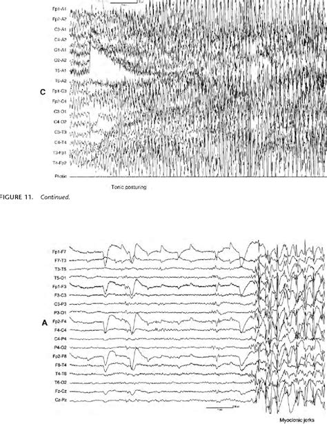 Figure 11 from The EEG in selected generalized seizures. | Semantic Scholar