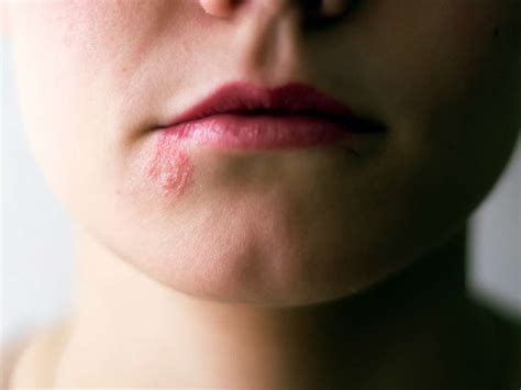 Shingles: Symptoms, pictures, treatments, and more