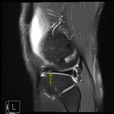 Case Study: Knee Arthroscopic Lateral Meniscus and Microfracture ...