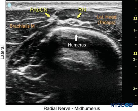 Ultrasound-Guided Blocks at the Elbow - NYSORA | NYSORA