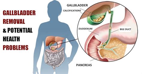 Does Gallbladder Removal Lead To Weight Gain – Blog Dandk