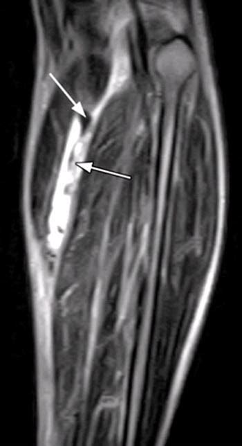 Tennis Leg / Plantaris Tendon Rupture | Radsource