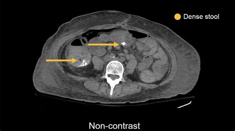 Abdominal CT: Phases • LITFL • Radiology library