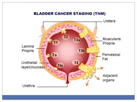 Renal 2: Hematuria and Bladder Cancer Flashcards | Quizlet