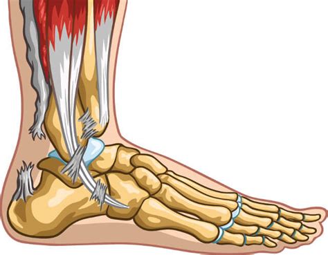 Achilles Tendon Rupture Treatment | Johns Hopkins Department of Orthopaedic Surgery