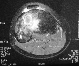 Benign Fibrous Histiocytoma