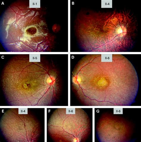 Characterisation of severe rod–cone dystrophy in a consanguineous family with a splice site ...