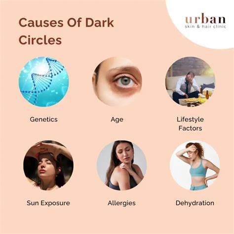 Dark Circles Types, Causes, Symptoms & Treatment