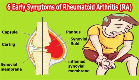 6 Early Symptoms of Rheumatoid Arthritis (RA) | Rheumatoid arthritis ...