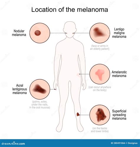 Melanoma Stages Poster Cartoon Vector | CartoonDealer.com #274843445