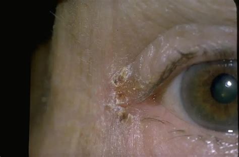 Angular blepharitis - American Academy of Ophthalmology