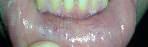 White gums? A sign of oral STD? : r/STD