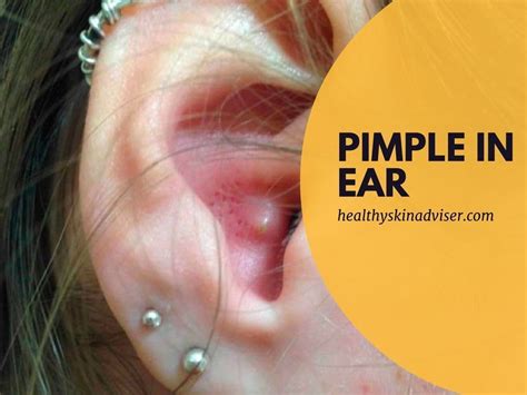 This your preferred guide on how to get rid of a pimple in ear. Learn the basics of pimple in ...