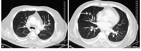 Chest CT showing a 9 ? 14 mm irregular nodule in the right middle lobe... | Download Scientific ...