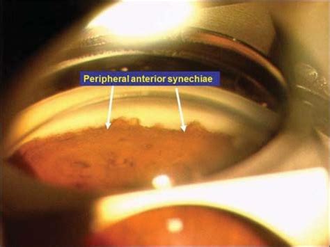 Peripheral Anterior... - Ophthalmology-Notes And Synopses