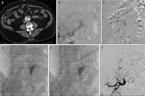 Endovascular Today - Management of Type II Endoleaks (April 2016)