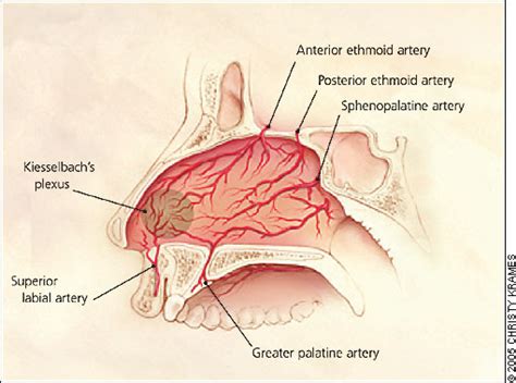 Epistaxis - Cancer Therapy Advisor