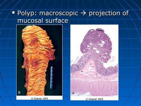 Neoplasia classification