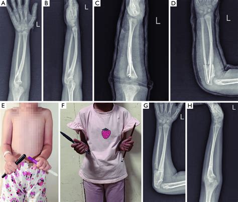 A 5-year-old female patient who underwent proximal radioulnar ...