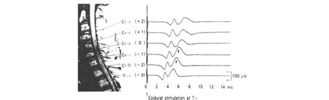 Variability In Somatosensory Evoked Potential Test: Summing It Up