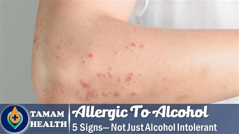 5 Signs You're Allergic To Alcohol — Not Just Alcohol Intolerant - YouTube