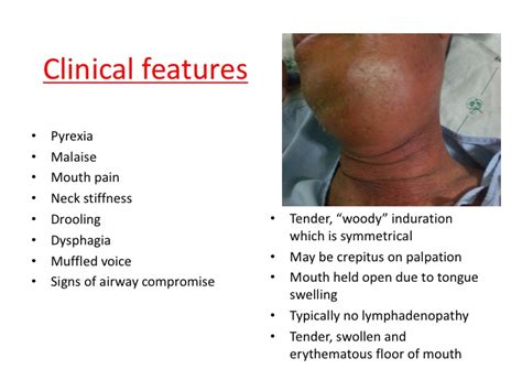 ludwig's angina — learnED