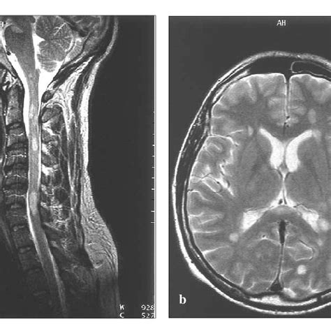 T2 Hyperintense Lesion Brain Differential Diagnosis