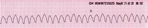 Ventricular tachycardia diagnosis - wikidoc