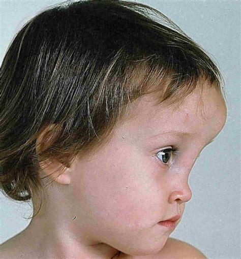 Encephalocele types, causes, symptoms, prognosis, repair & treatment