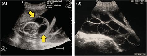 Transabdominal ultrasound examination. (A) Axial view of the fetus... | Download Scientific Diagram