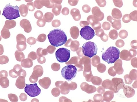 Ph+ Acute Lymphoblastic Leukemia - 2.