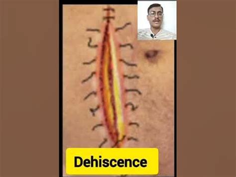 Wound Dehiscence and Evisceration #Shorts #viral #health #illness # ...