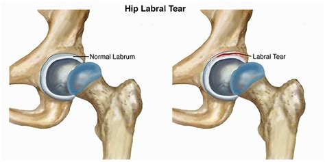 Hip Labrum Tears - Orchard Health Clinic - Osteopathy, Physiotherapy and Chiropractic