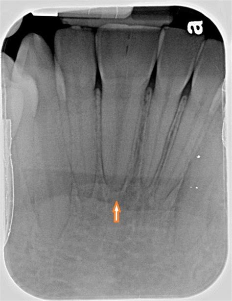 Gemination of Teeth - Bite Point