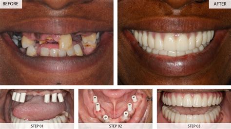 Dental Implants Results (Before & After) - 22 Cases