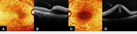 Both eye OCT macula at day 3 of dengue fever (A, B): OCT of RE showed ...