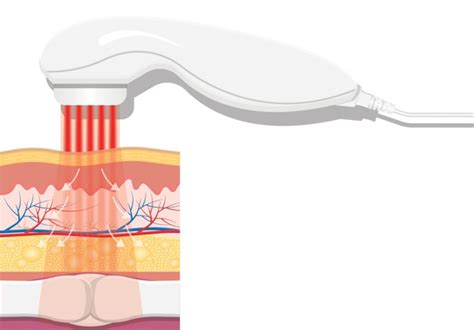 Cold Laser Therapy for Acute and Chronic Pain Management | Anesthesia ...