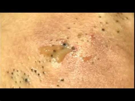 🔴SO SO SO MANY BLACKHEAD REMOVAL ON BACK - YouTube