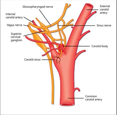 Figure 1 from Carotid Sinus/Nerve Stimulation for Treatment of Resistant Hypertension and Heart ...