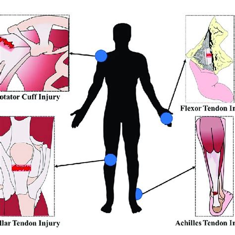 Schematic diagram of the sites of tendon injuries that frequently occur... | Download Scientific ...