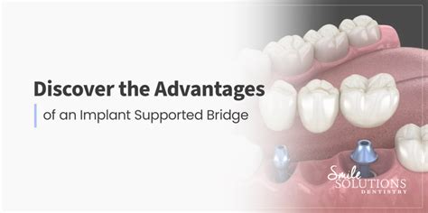 Discover the Advantages of an Implant-Supported Bridge