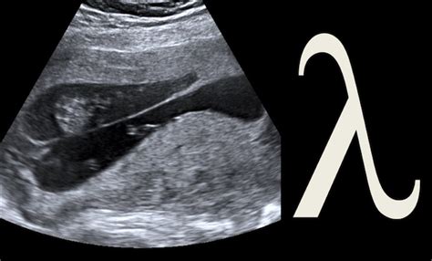 Radiology Signs • Lambda sign - describes the triangular appearance...