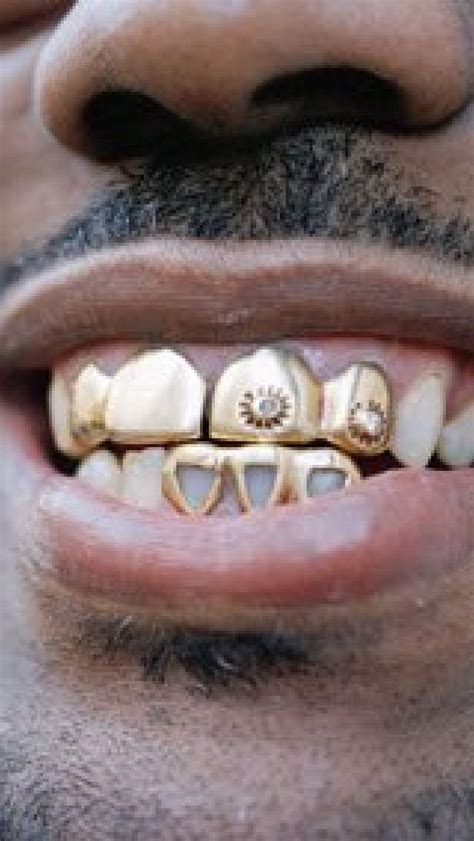 How Long Does A Gold Tooth Crown Last - Dwain Austin Hochzeitstorte