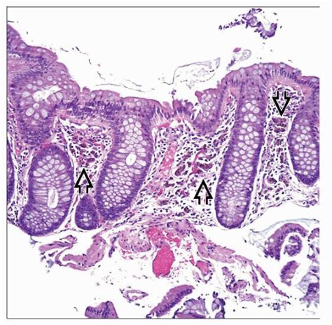 Melanosis Coli | Basicmedical Key