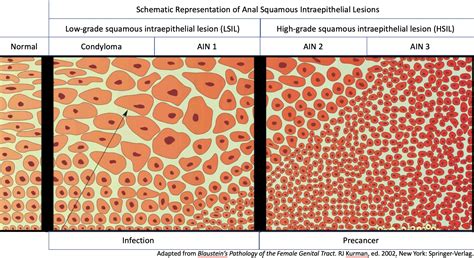 Anal Pre-Cancer: Squamous Intraepithelial Lesions | Anal Neoplasia Clinic, Research and ...