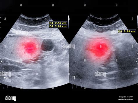 Ultrasound upper abdomen for diagnosis abdominal pain Stock Photo - Alamy